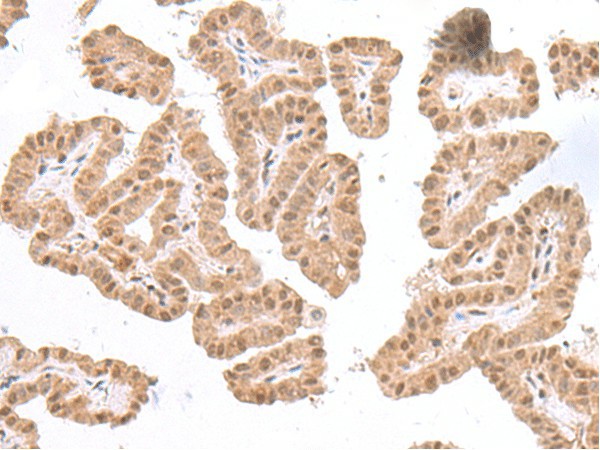 Immunohistochemistry of paraffin-embedded Human thyroid cancer tissue  using TDP2 Polyclonal Antibody at dilution of 1:75(?200)