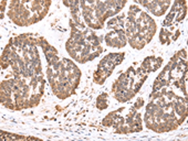 Immunohistochemistry of paraffin-embedded Human esophagus cancer tissue  using DDX58 Polyclonal Antibody at dilution of 1:35(?200)