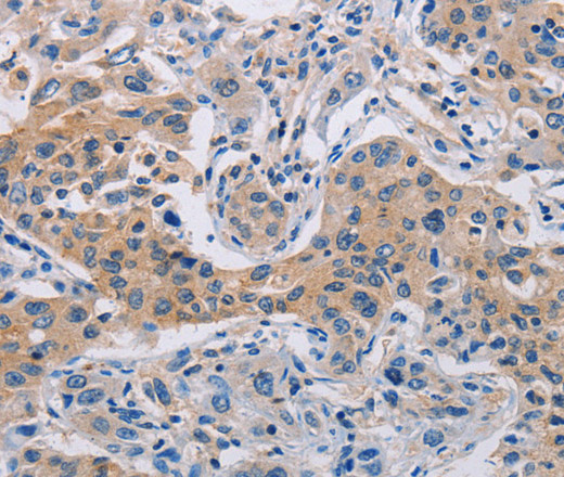 Immunohistochemistry of paraffin-embedded Human lung cancer tissue using CASP10 Polyclonal Antibody at dilution 1:30