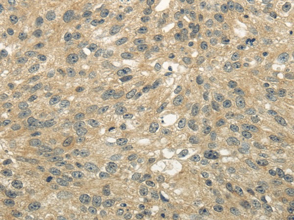 Immunohistochemistry of paraffin-embedded Human breast cancer tissue using UGT2B4 Polyclonal Antibody at dilution 1:45