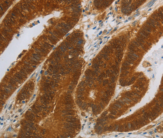 Immunohistochemistry of paraffin-embedded Human colon cancer using NIT2 Polyclonal Antibody at dilution of 1:40