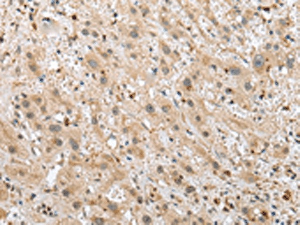 Immunohistochemistry of paraffin-embedded Human liver cancer tissue  using TPPP Polyclonal Antibody at dilution of 1:25(?200)