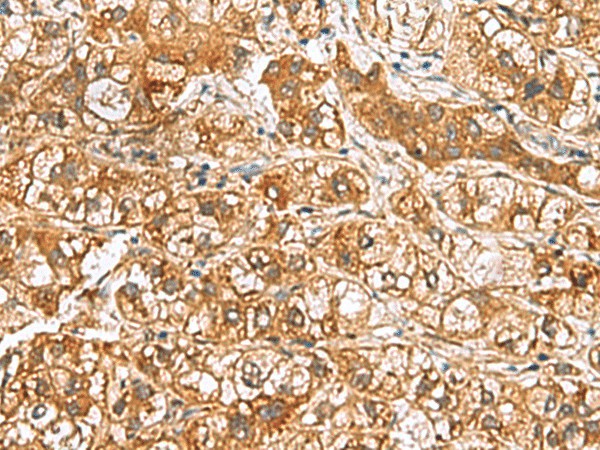 Immunohistochemistry of paraffin-embedded Human liver cancer tissue  using RIDA Polyclonal Antibody at dilution of 1:65(?200)