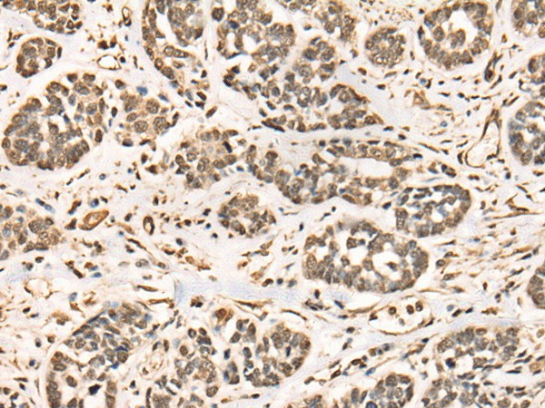 Immunohistochemistry of paraffin-embedded Human esophagus cancer tissue  using BRD7 Polyclonal Antibody at dilution of 1:50(?200)