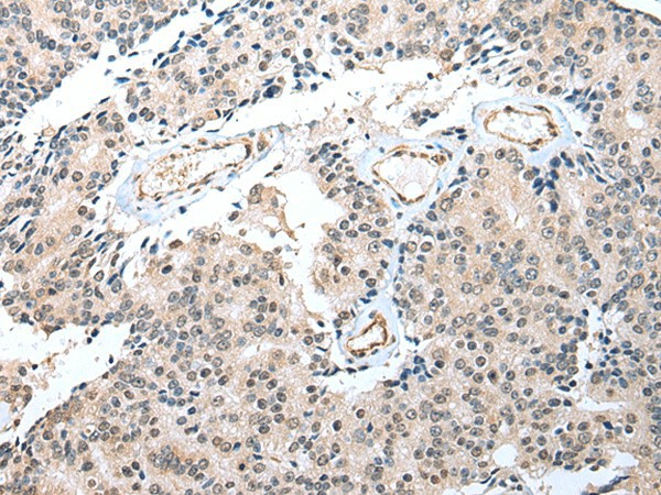 Immunohistochemistry of paraffin-embedded Human prost at e cancer tissue  using S100A16 Polyclonal Antibody at dilution of 1:25(?200)