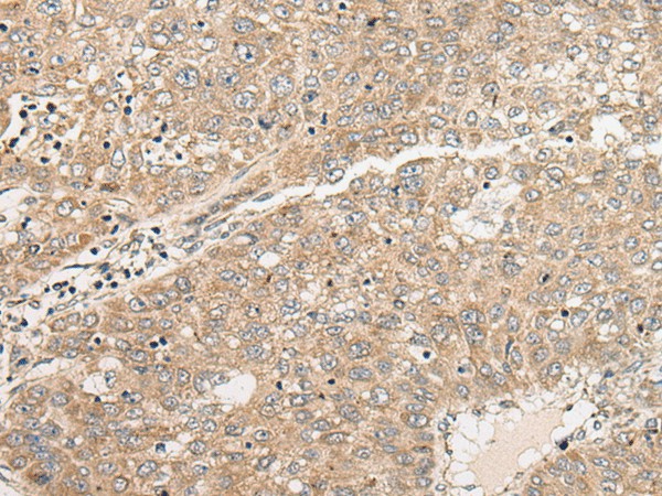 Immunohistochemistry of paraffin-embedded Human liver cancer tissue  using C1orf101 Polyclonal Antibody at dilution of 1:45(?200)