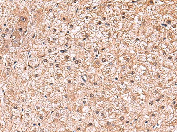 Immunohistochemistry of paraffin-embedded Human liver cancer tissue  using RUSC1 Polyclonal Antibody at dilution of 1:90(?200)