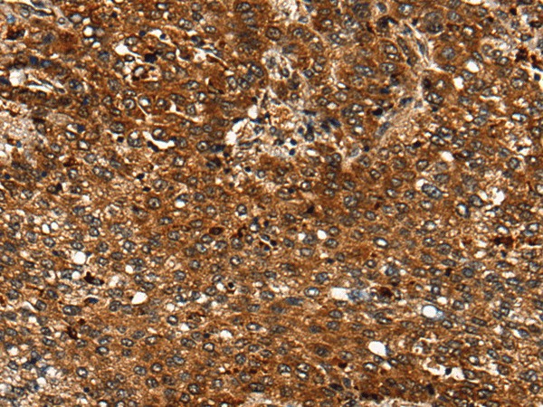 Immunohistochemistry of paraffin-embedded Human liver cancer tissue  using CDKL4 Polyclonal Antibody at dilution of 1:35(?200)