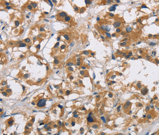 Immunohistochemistry of paraffin-embedded Human thyroid cancer tissue using CYP21A2 Polyclonal Antibody at dilution 1:60