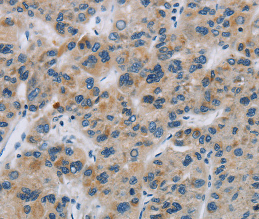 Immunohistochemistry of paraffin-embedded Human liver cancer using SYN2 Polyclonal Antibody at dilution of 1:40