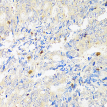 Immunohistochemistry of paraffin-embedded Human rectal cancer using STAT4 Polyclonal Antibody at dilution of 1:100 (40x lens).