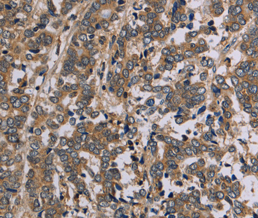 Immunohistochemistry of paraffin-embedded Human liver cancer tissue using AATK Polyclonal Antibody at dilution 1:45