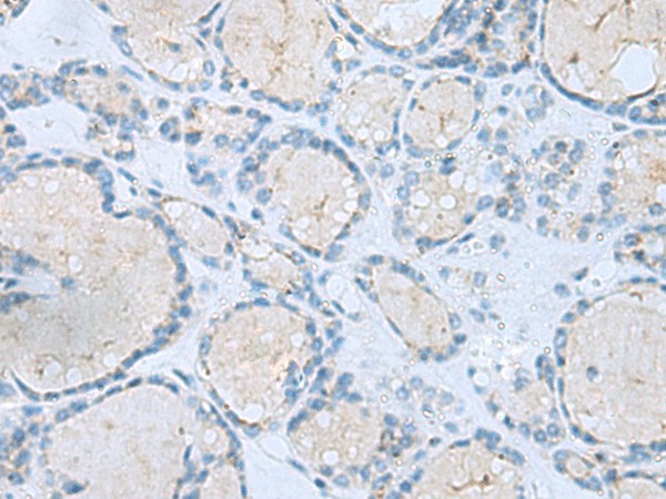 Immunohistochemistry of paraffin-embedded Human thyroid cancer tissue  using MSI2 Polyclonal Antibody at dilution of 1:60(?200)