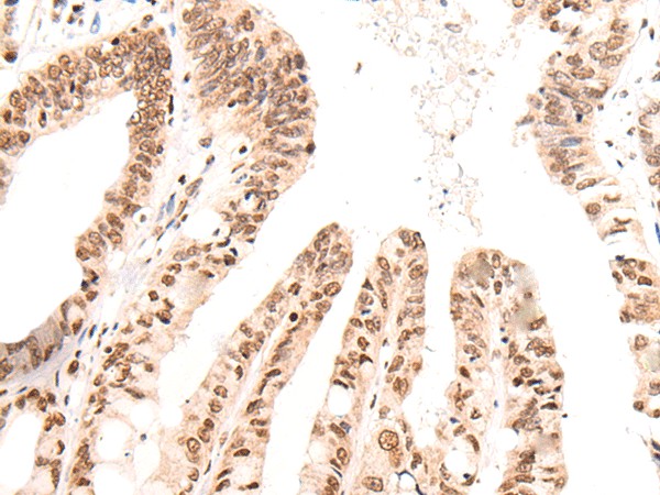 Immunohistochemistry of paraffin-embedded Human liver cancer tissue  using KNOP1 Polyclonal Antibody at dilution of 1:55(?200)