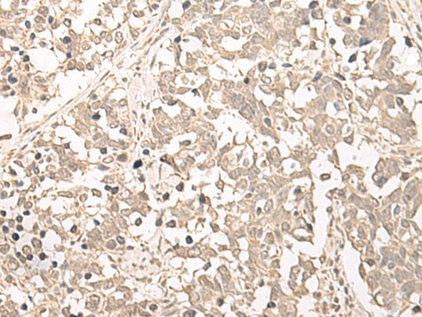 Immunohistochemistry of paraffin-embedded Human lung cancer tissue  using RRP1 Polyclonal Antibody at dilution of 1:45(?200)