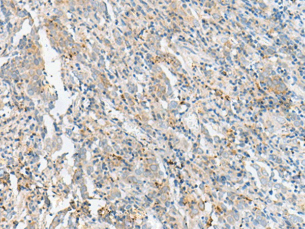 Immunohistochemistry of paraffin-embedded Human cervical cancer tissue  using CTRB1 Polyclonal Antibody at dilution of 1:60(?200)