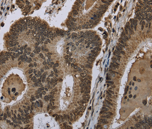 Immunohistochemistry of paraffin-embedded Human colon cancer using HIST1H2AH Polyclonal Antibody at dilution of 1:40