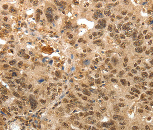 Immunohistochemistry of paraffin-embedded Human lung cancer tissue using TNXB Polyclonal Antibody at dilution 1:30