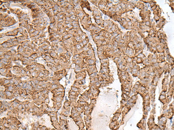 Immunohistochemistry of paraffin-embedded Human thyroid cancer tissue  using AP1S1 Polyclonal Antibody at dilution of 1:65(?200)