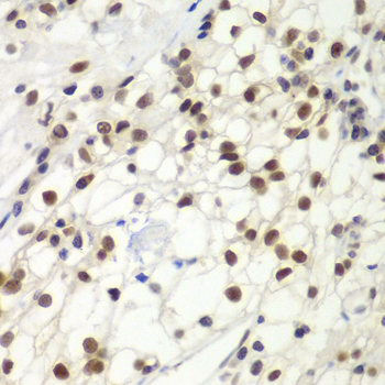 Immunohistochemistry of paraffin-embedded Human kidney cancer using MSH6 Polyclonal Antibody at dilution of 1:100 (40x lens).