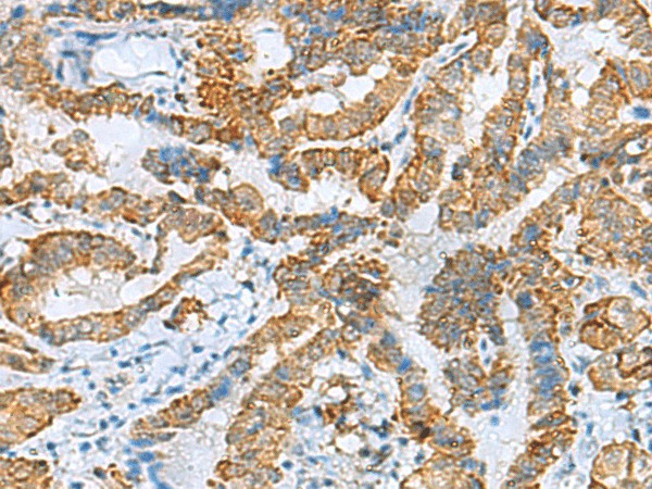 Immunohistochemistry of paraffin-embedded Human thyroid cancer tissue  using FBXO8 Polyclonal Antibody at dilution of 1:40(?200)