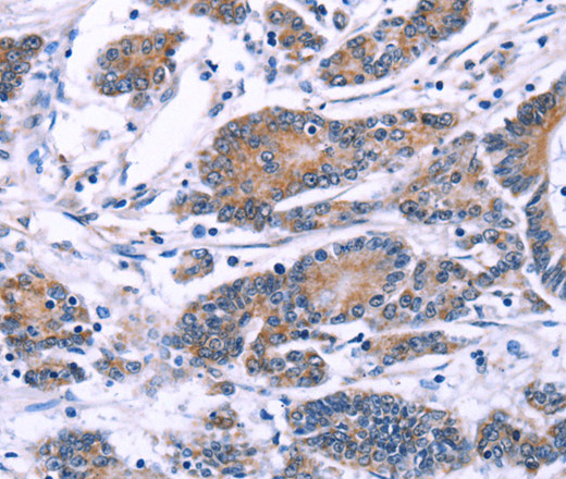 Immunohistochemistry of paraffin-embedded Human colon cancer using SYT4 Polyclonal Antibody at dilution of 1:60