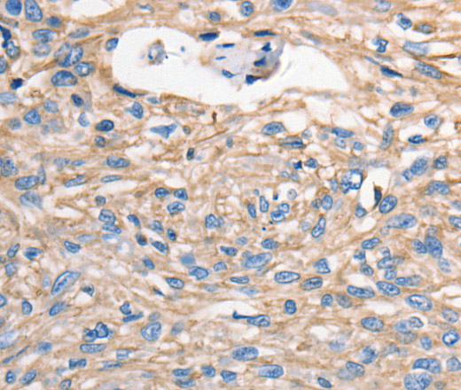 Immunohistochemistry of paraffin-embedded Human esophagus cancer using MVP Polyclonal Antibody at dilution of 1:40