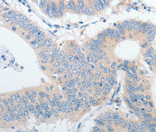 Immunohistochemistry of paraffin-embedded Human colon cancer using IGFBP1 Polyclonal Antibody at dilution of 1:30