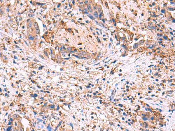 Immunohistochemistry of paraffin-embedded Human cervical cancer tissue  using MPP1 Polyclonal Antibody at dilution of 1:50(?200)