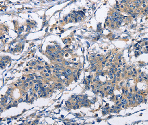 Immunohistochemistry of paraffin-embedded Human gastric cancer using CAPZA2 Polyclonal Antibody at dilution of 1:30