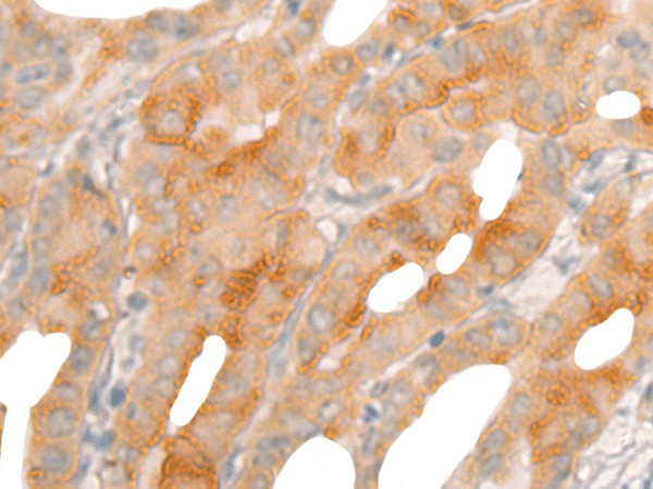 Immunohistochemistry of paraffin-embedded Human thyroid cancer tissue  using BBOX1 Polyclonal Antibody at dilution of 1:50(?200)