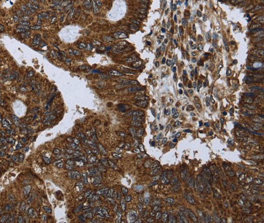 Immunohistochemistry of paraffin-embedded Human colon cancer using PPP1R13L Polyclonal Antibody at dilution of 1:30