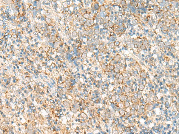 Immunohistochemistry of paraffin-embedded Human cervical cancer tissue  using PSD4 Polyclonal Antibody at dilution of 1:50(?200)