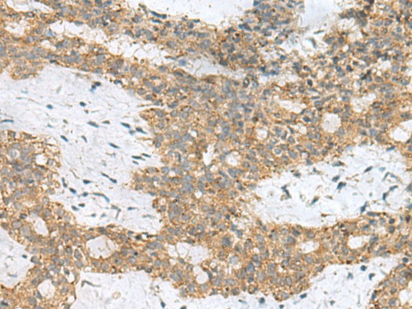 Immunohistochemistry of paraffin-embedded Human breast cancer tissue  using SKI Polyclonal Antibody at dilution of 1:70(?200)