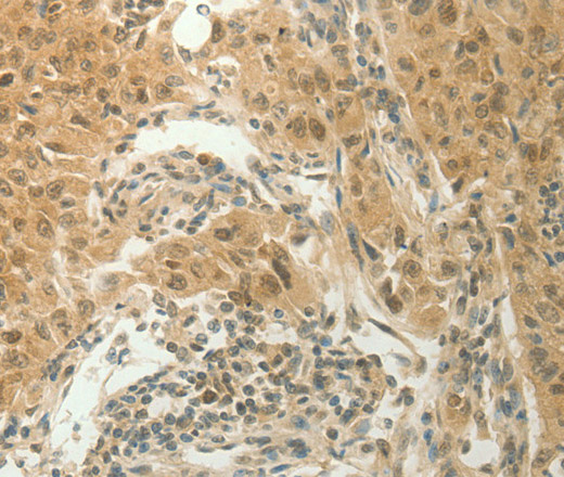 Immunohistochemistry of paraffin-embedded Human lung cancer tissue using SLC8A3 Polyclonal Antibody at dilution 1:70