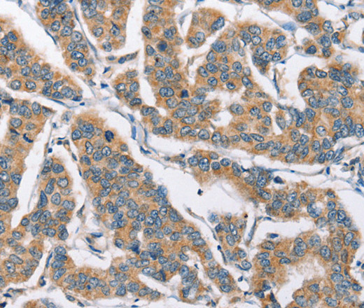 Immunohistochemistry of paraffin-embedded Human breast cancer tissue using CAMK4 Polyclonal Antibody at dilution 1:40