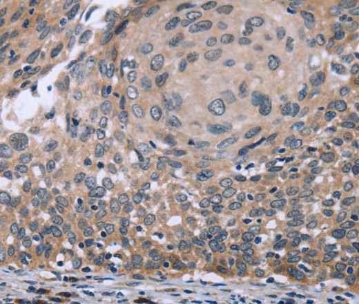 Immunohistochemistry of paraffin-embedded Human cervical cancer using p53RFP Polyclonal Antibody at dilution of 1:50