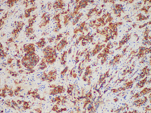 Immunohistochemistry of paraffinembedded Human pituitary tumor tissue with PRL Monoclonal Antibody(Antigen repaired by EDTA).