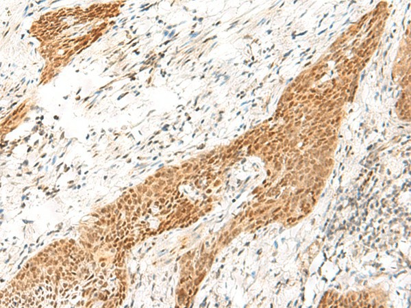 Immunohistochemistry of paraffin-embedded Human esophagus cancer tissue  using RPS27A Polyclonal Antibody at dilution of 1:35(?200)