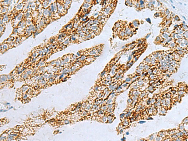 Immunohistochemistry of paraffin-embedded Human gastric cancer tissue  using PYCR2 Polyclonal Antibody at dilution of 1:40(?200)