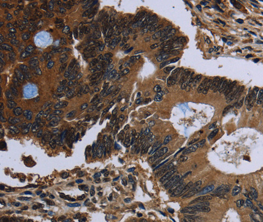 Immunohistochemistry of paraffin-embedded Human colon cancer using IRGM Polyclonal Antibody at dilution of 1:60