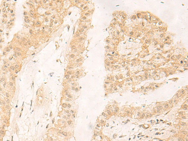 Immunohistochemistry of paraffin-embedded Human liver cancer tissue  using RBX1 Polyclonal Antibody at dilution of 1:30(?200)