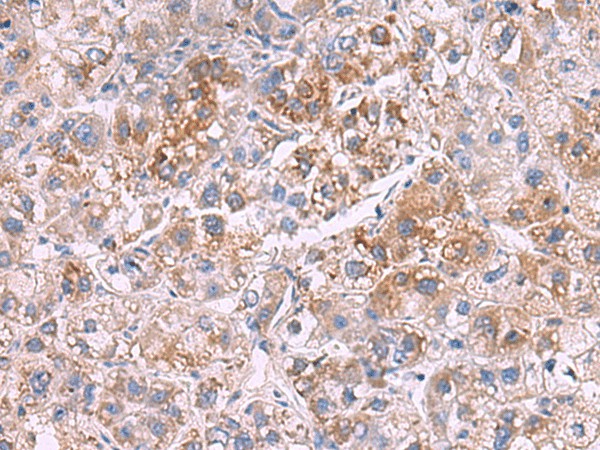 Immunohistochemistry of paraffin-embedded Human liver cancer tissue  using GSTCD Polyclonal Antibody at dilution of 1:70(?200)