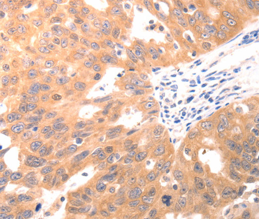 Immunohistochemistry of paraffin-embedded Human ovarian cancer using CAPNS1 Polyclonal Antibody at dilution of 1:60