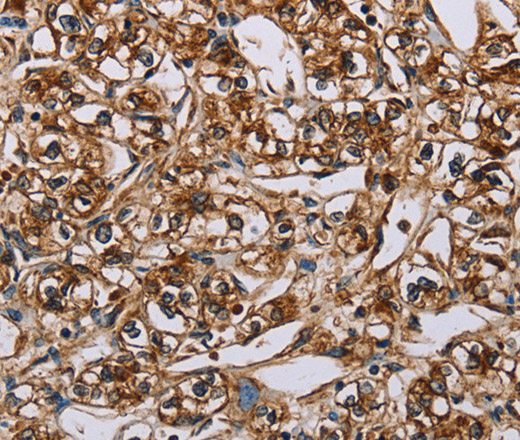 Immunohistochemistry of paraffin-embedded Human prostate cancer using BMP6 Polyclonal Antibody at dilution of 1:50
