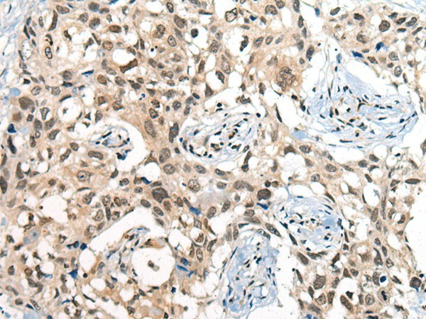 Immunohistochemistry of paraffin-embedded Human lung cancer tissue  using CDKL2 Polyclonal Antibody at dilution of 1:25(?200)