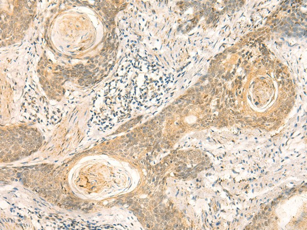 Immunohistochemistry of paraffin-embedded Human esophagus cancer tissue  using NIP7 Polyclonal Antibody at dilution of 1:50(?200)