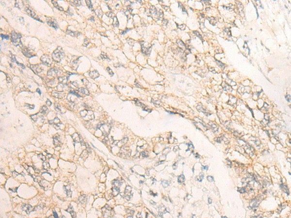 Immunohistochemistry of paraffin-embedded Human gastric cancer tissue  using DMTN Polyclonal Antibody at dilution of 1:35(?200)