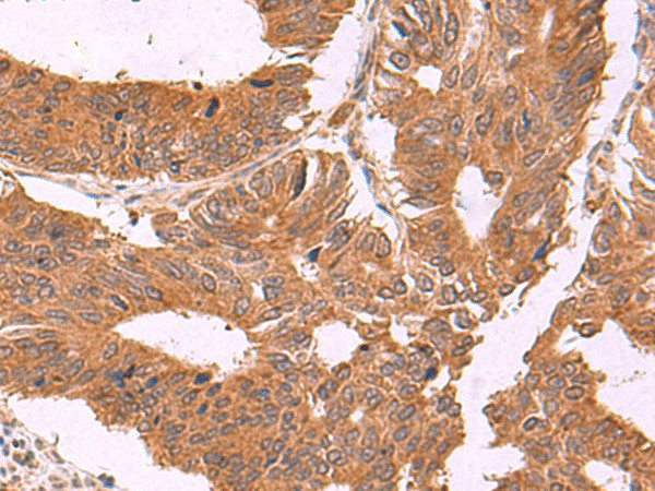 Immunohistochemistry of paraffin-embedded Human colorectal cancer tissue  using ZBTB33 Polyclonal Antibody at dilution of 1:30(?200)