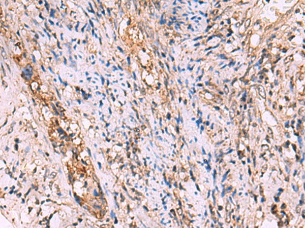 Immunohistochemistry of paraffin-embedded Human cervical cancer tissue  using GALK2 Polyclonal Antibody at dilution of 1:95(?200)